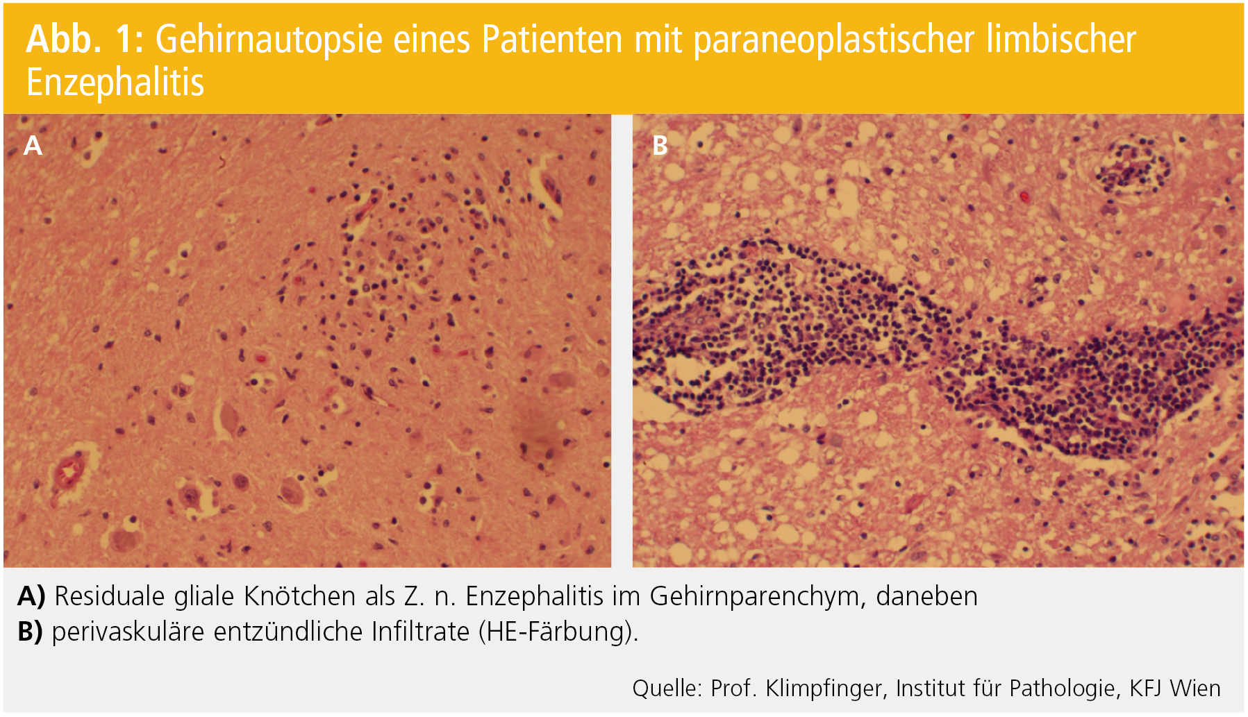 Neurologische Symptome im Rahmen von paraneoplastischen Syndrome n